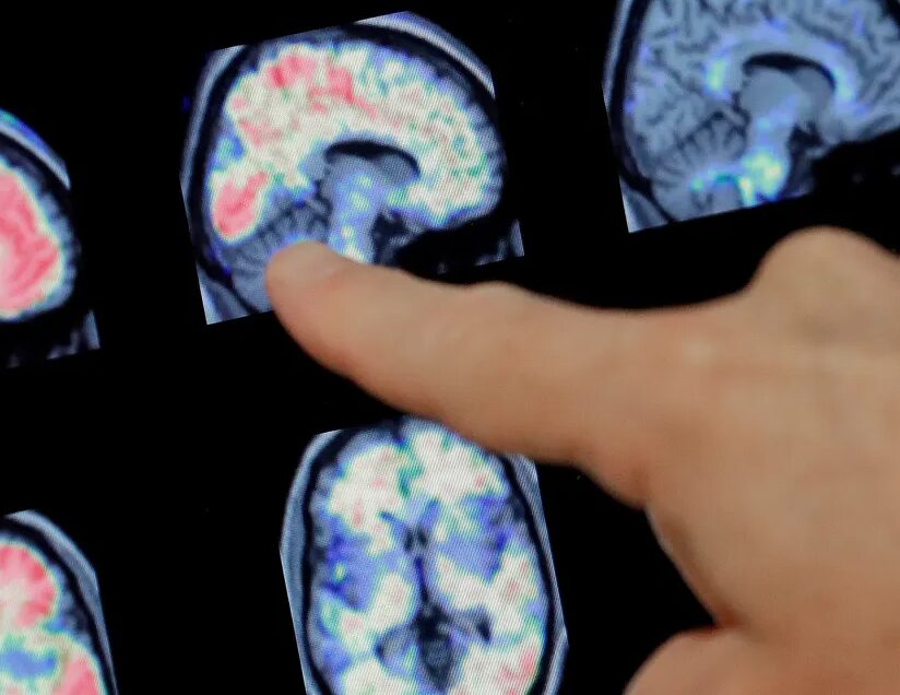 We need an urgent and unified response to the coming Alzheimer’s crisis | Chicago Tribune | Colonel (Ret.) Robert R. Redfield, MD